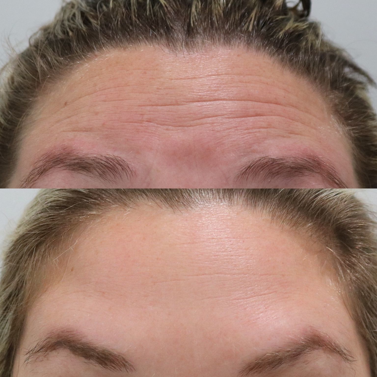 Botox Before and After Photo by Liv Aesthetics Medical Spa in New Fairfield, CT