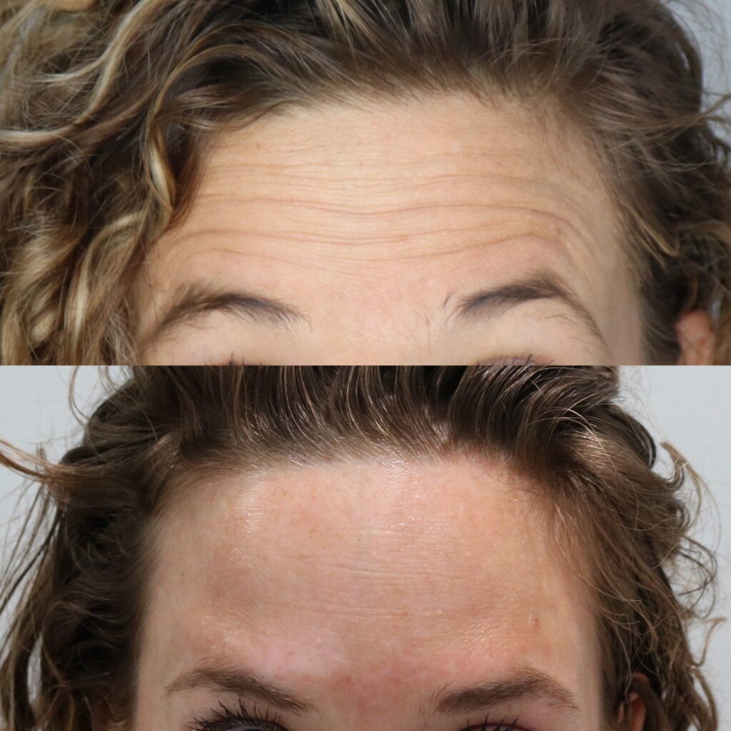 Botox Before and After Photo by Liv Aesthetics Medical Spa in New Fairfield, CT
