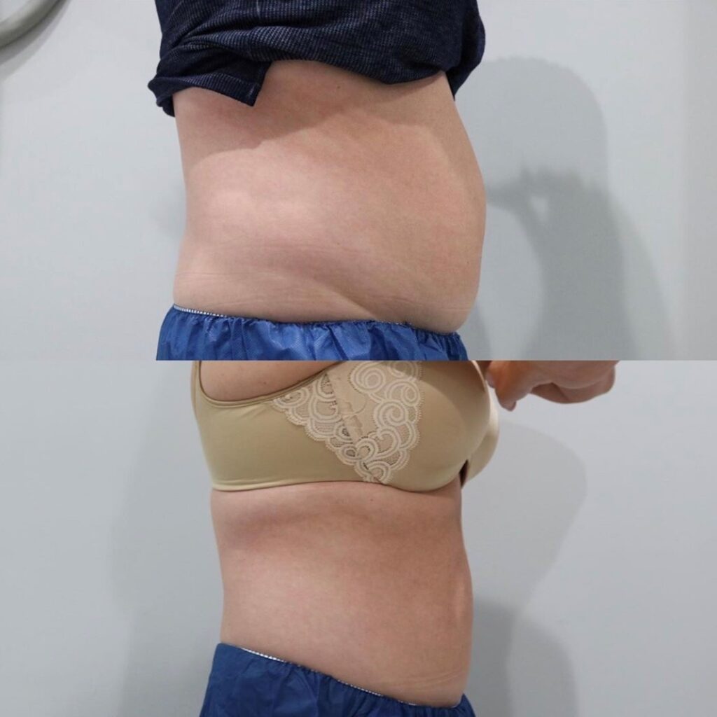 CoolSculpting Before and After Photo by Liv Aesthetics Medical Spa in New Fairfield, CT