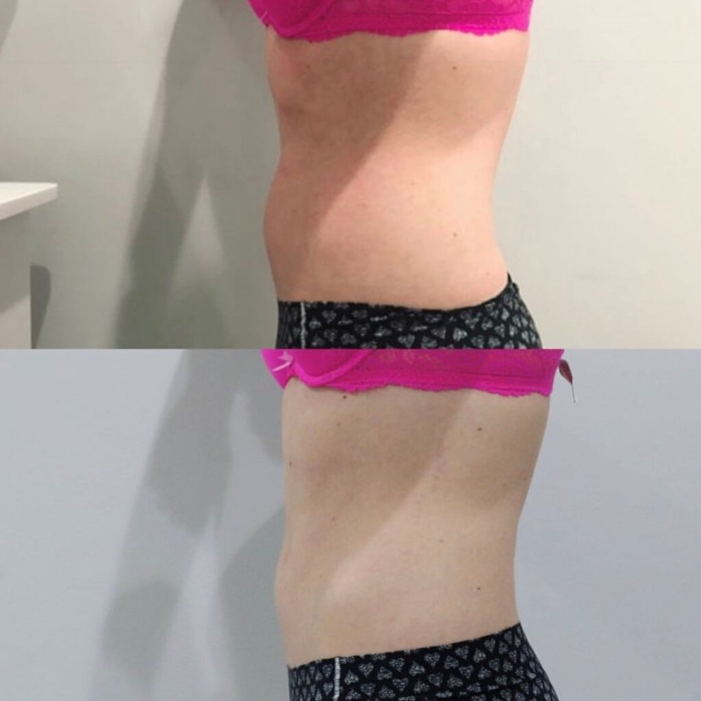 CoolSculpting Before and After Photo by Liv Aesthetics Medical Spa in New Fairfield, CT