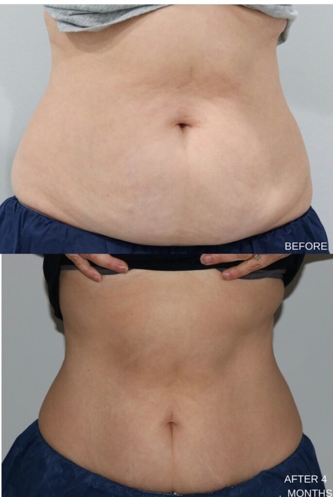 CoolSculpting Before and After Photo by Liv Aesthetics Medical Spa in New Fairfield, CT