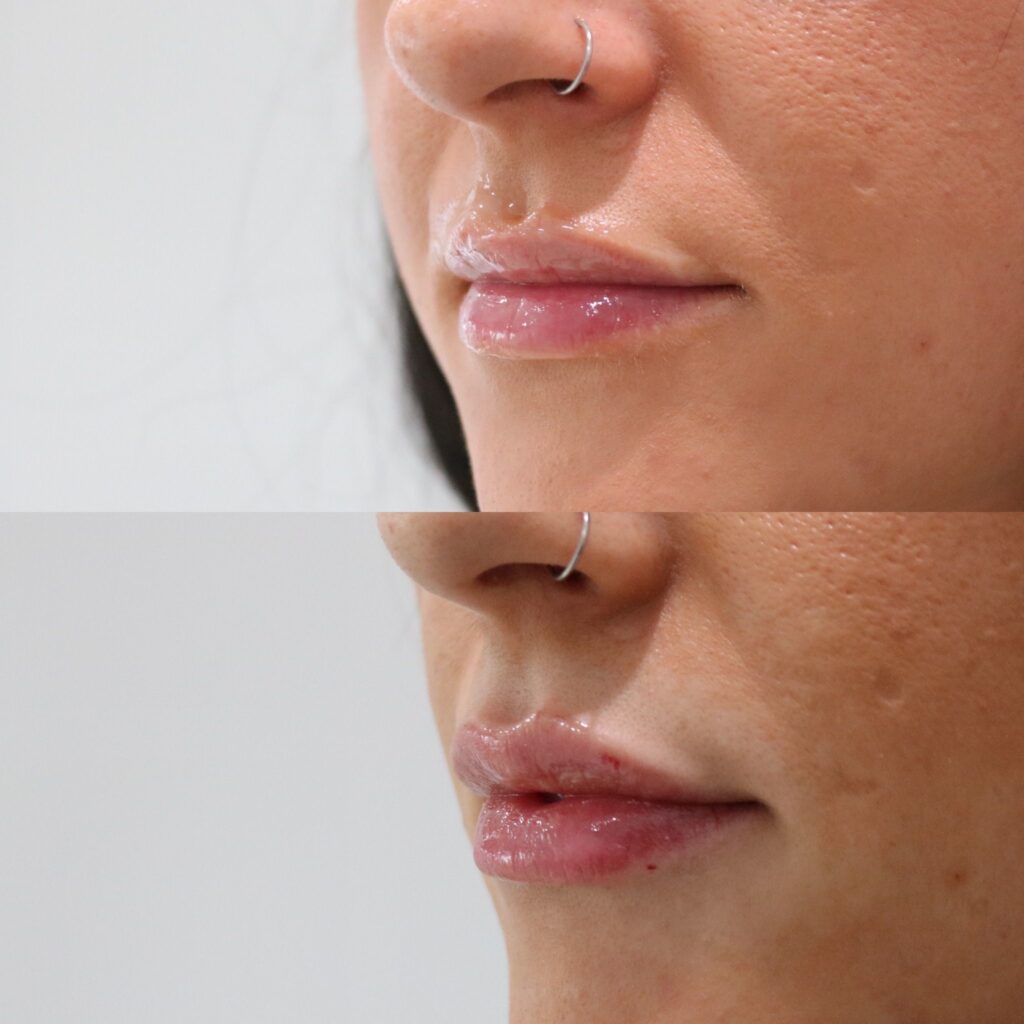 Lip Fillers Before and After Photo by Liv Aesthetics Medical Spa in New Fairfield, CT
