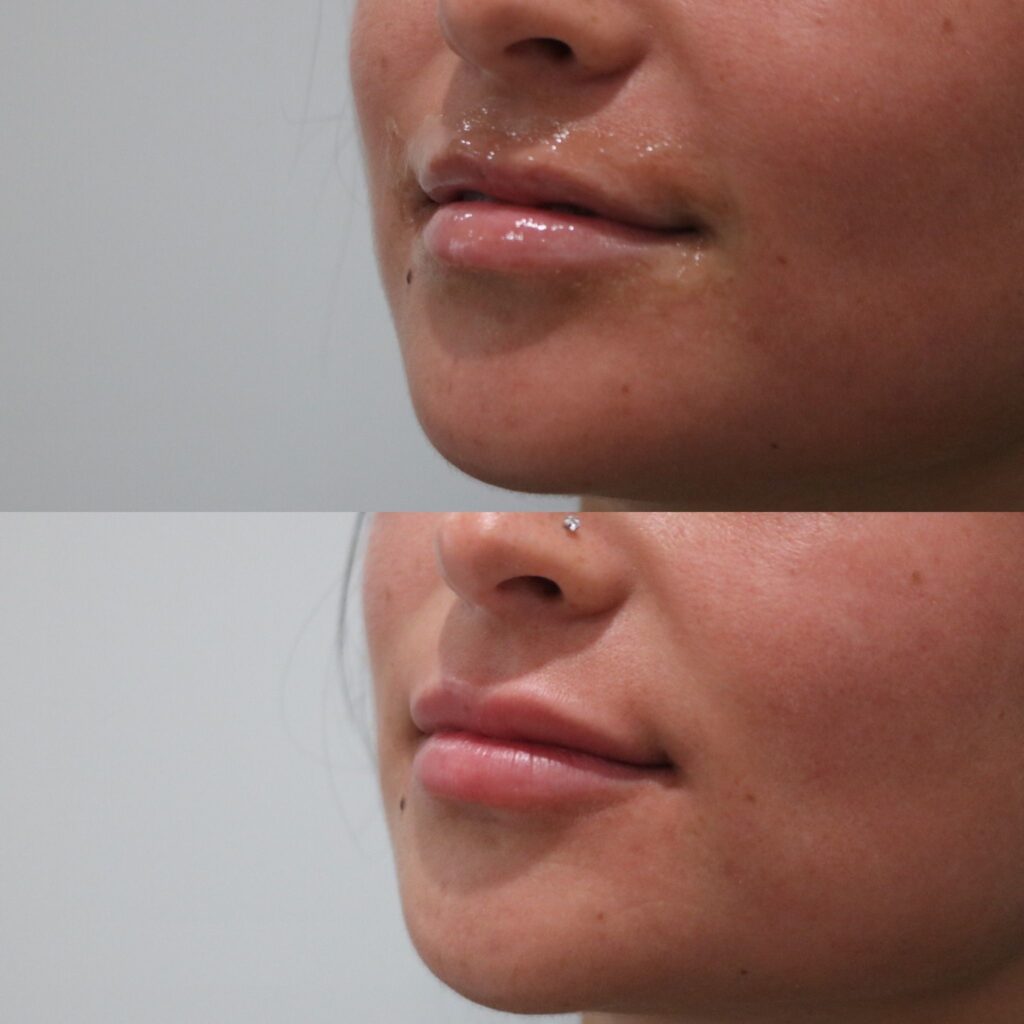 Lip Fillers Before and After Photo by Liv Aesthetics Medical Spa in New Fairfield, CT