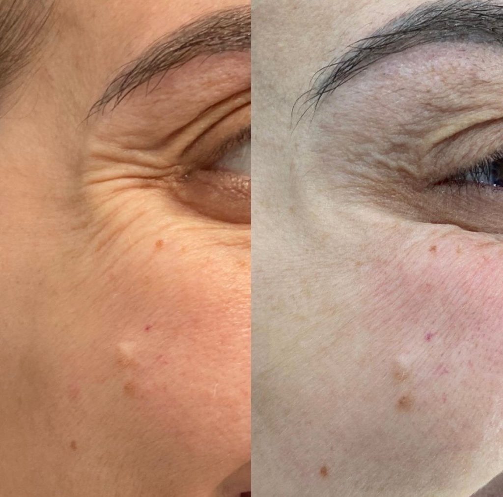 Botox Before and After Photo by Liv Aesthetics Medical Spa in New Fairfield CT