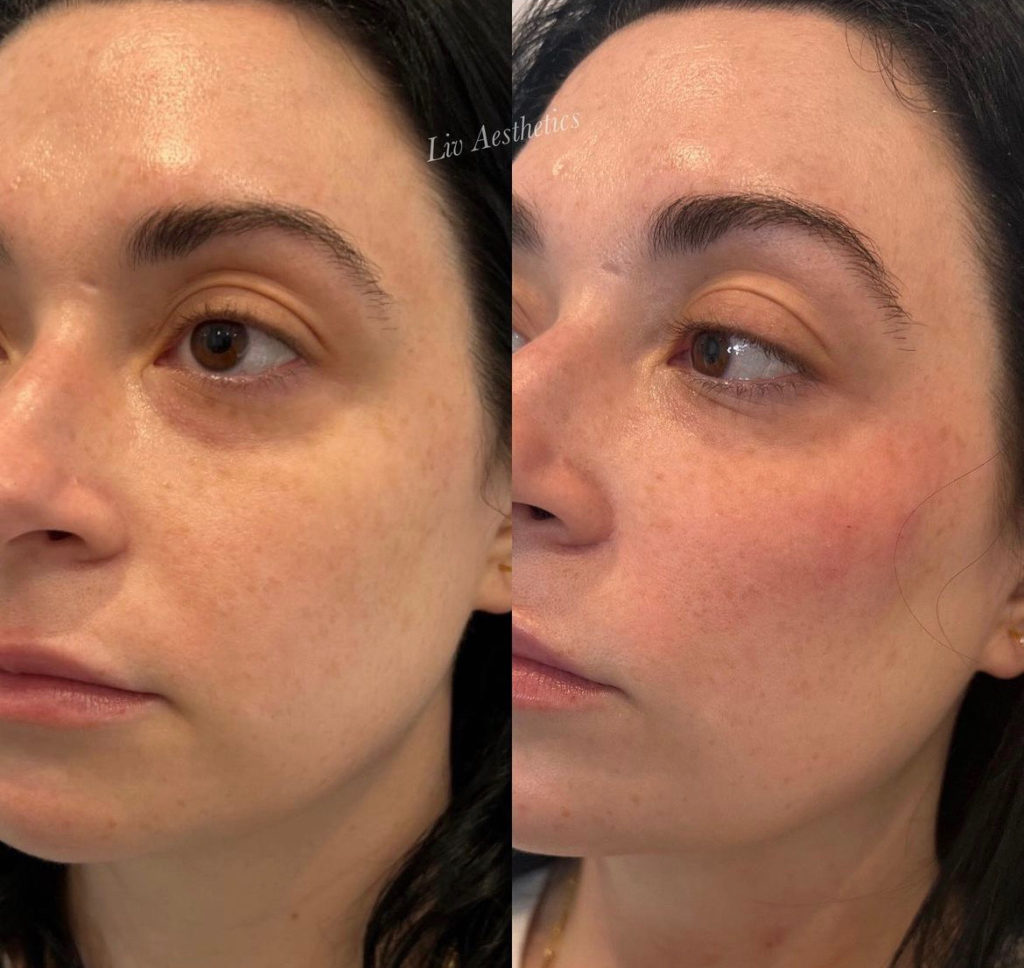 Facial Balancing Before and After Photo by Liv Aesthetics Medical Spa in New Fairfield CT