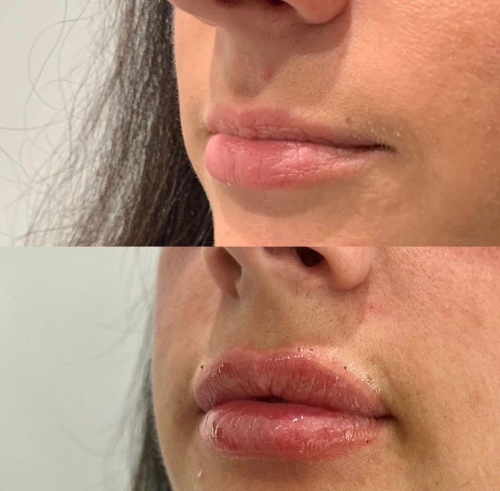 Lip Fillers Before and After Photo by Liv Aesthetics Medical Spa in New Fairfield CT