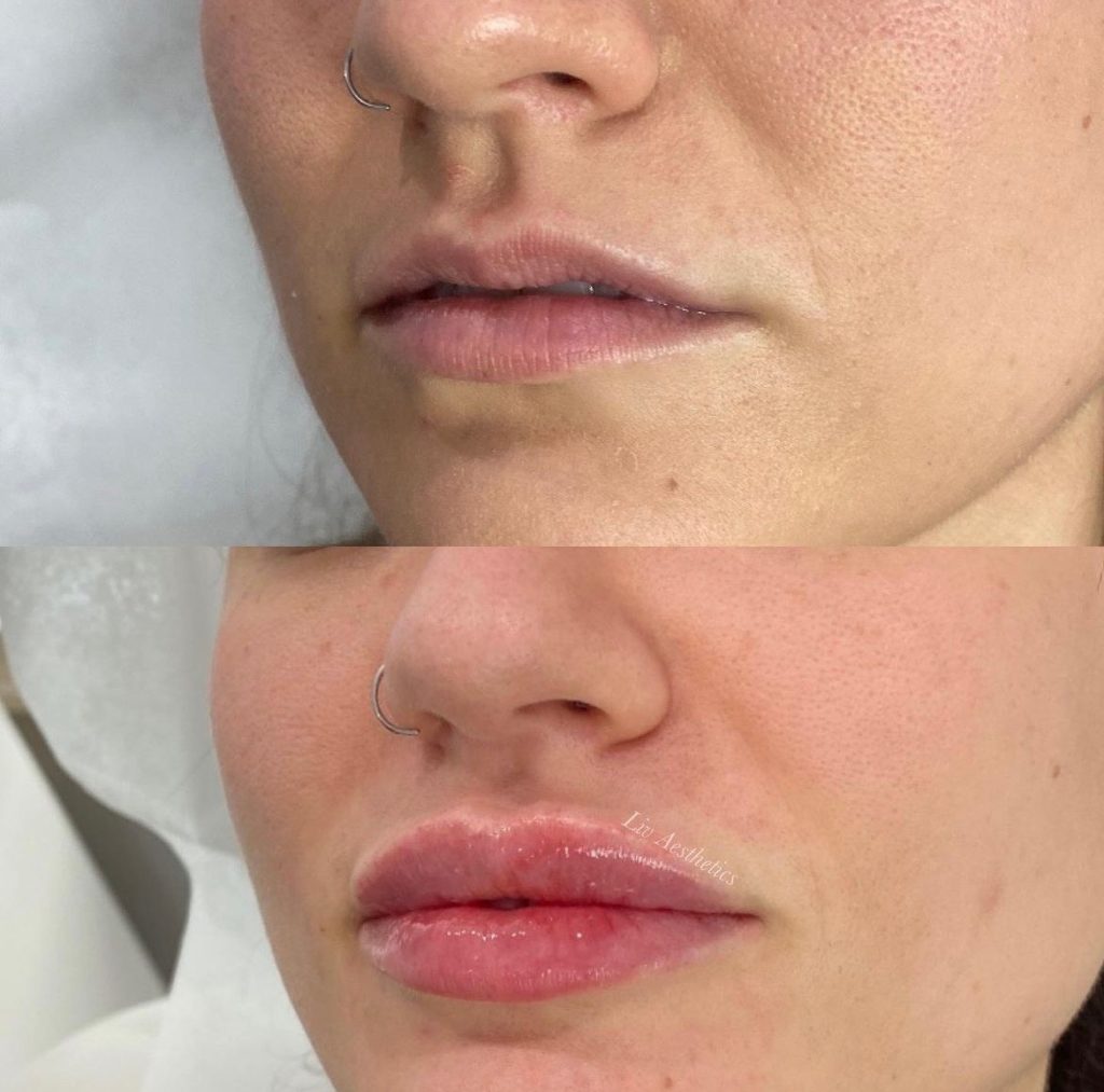 Lip Fillers Before and After Photo by Liv Aesthetics Medical Spa in New Fairfield CT