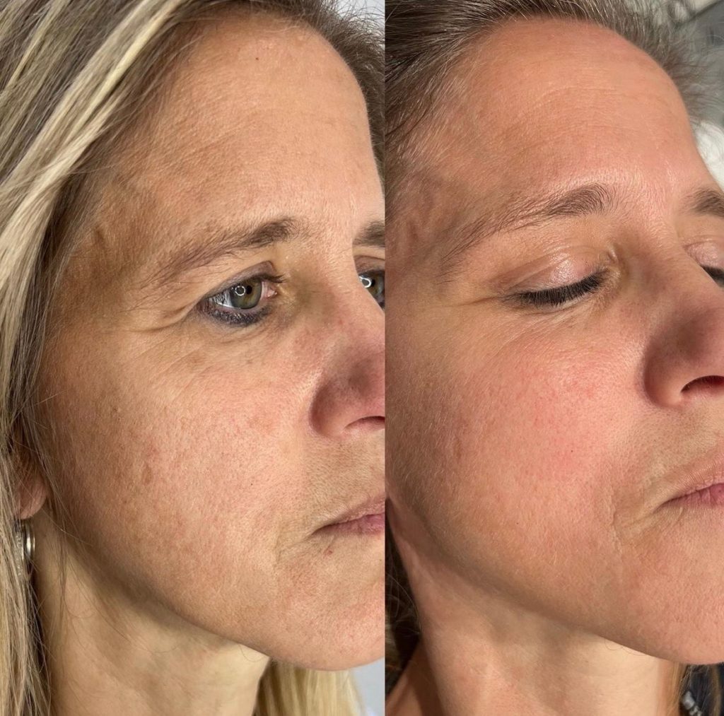 Total Skin Ultra Laser Treatment Before and After Photo by Liv Aesthetics Medical Spa in New Fairfield CT