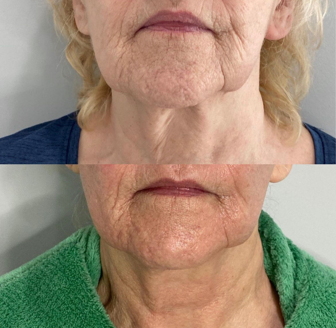 Total Skin Ultra Laser Treatment Before and After Photo by Liv Aesthetics Medical Spa in New Fairfield CT