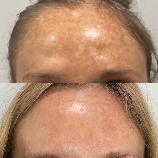 ultra laser before and after