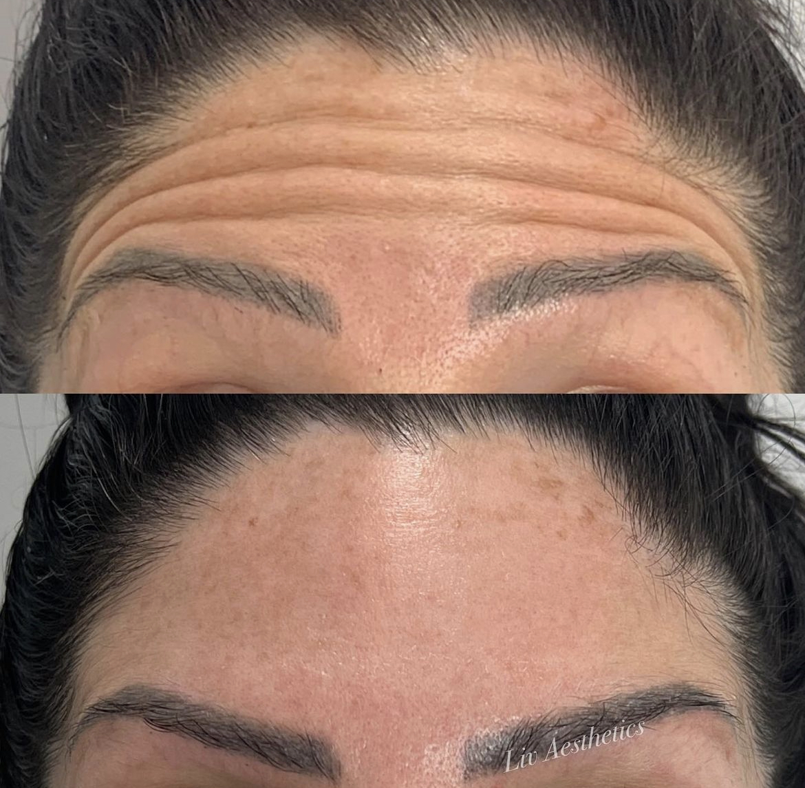 Botox before and after photo by Liv Aesthetics Medical Spa in New Fairfield, CT