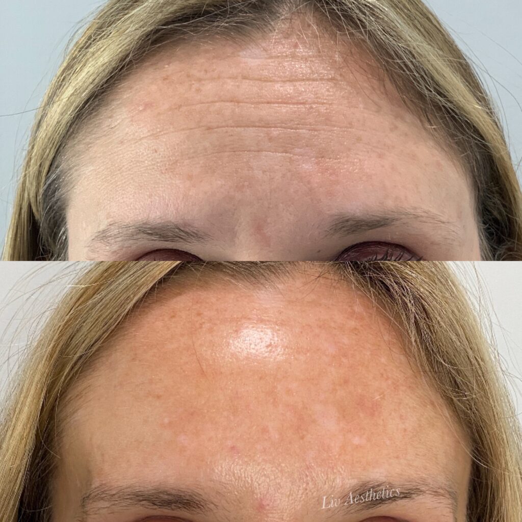 Botox before and after photo by Liv Aesthetics Medical Spa in New Fairfield, CT