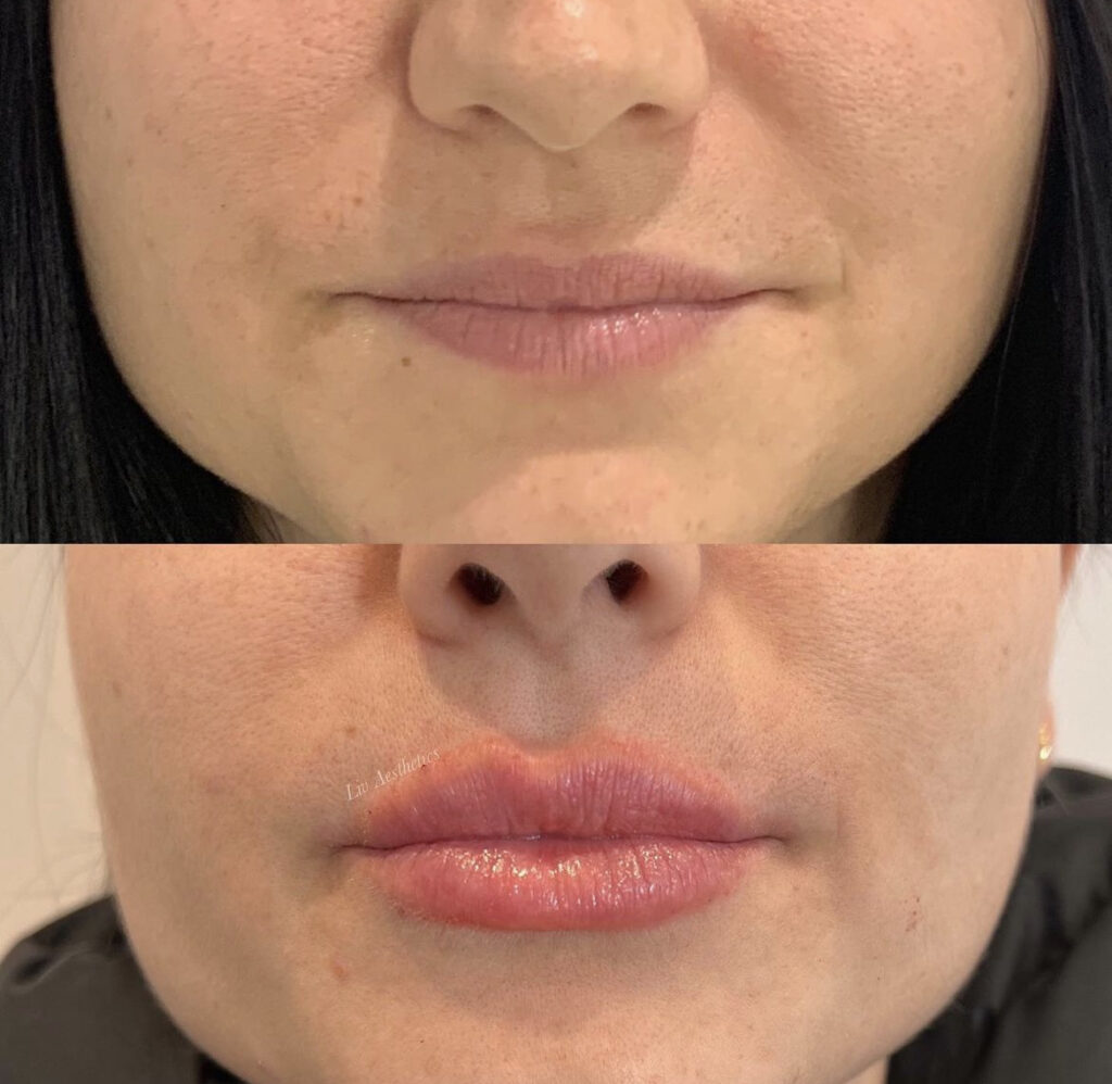 Lip Fillers before and after photo by Liv Aesthetics Medical Spa in New Fairfield, CT