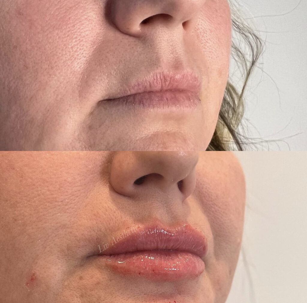 Lip Fillers before and after photo by Liv Aesthetics Medical Spa in New Fairfield, CT