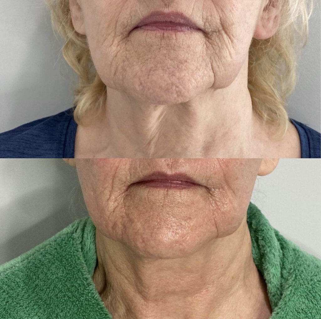 RF Microneedling before and after photo by Liv Aesthetics Medical Spa in New Fairfield, CT