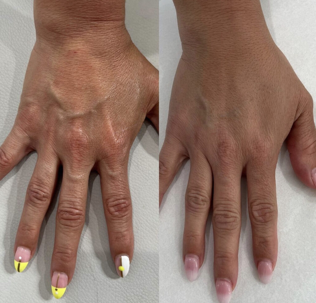 Radiesse before and after photo by Liv Aesthetics Medical Spa in New Fairfield, CT