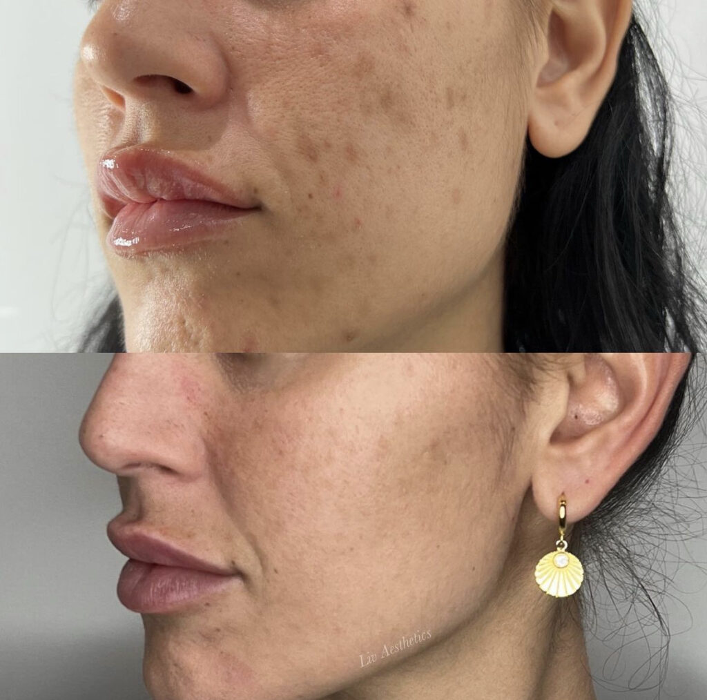 Ultra Laser Treatment before and after photo by Liv Aesthetics Medical Spa in New Fairfield, CT