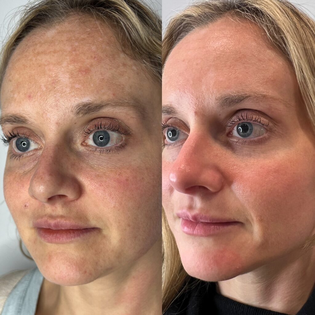 Ultra Laser Treatment before and after photo by Liv Aesthetics Medical Spa in New Fairfield, CT