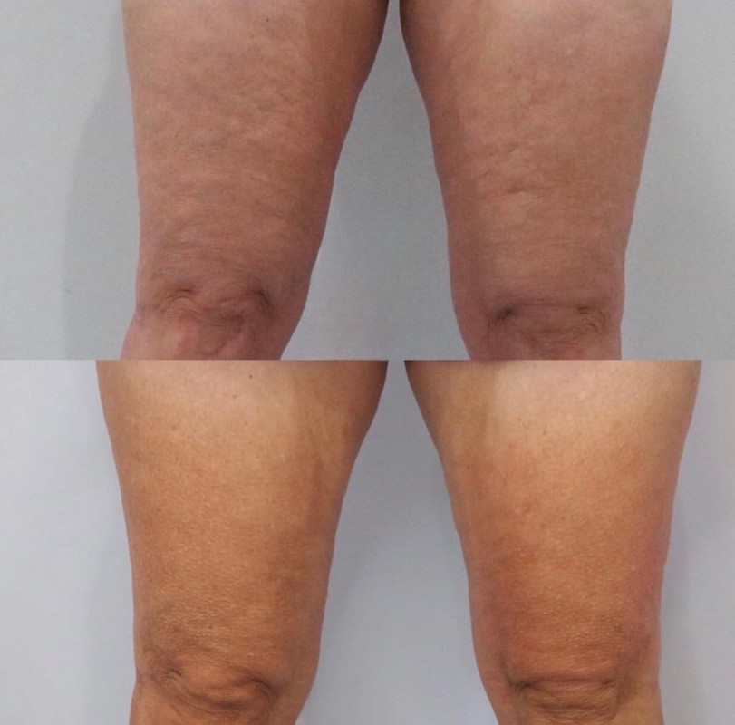 Cyro before and after results