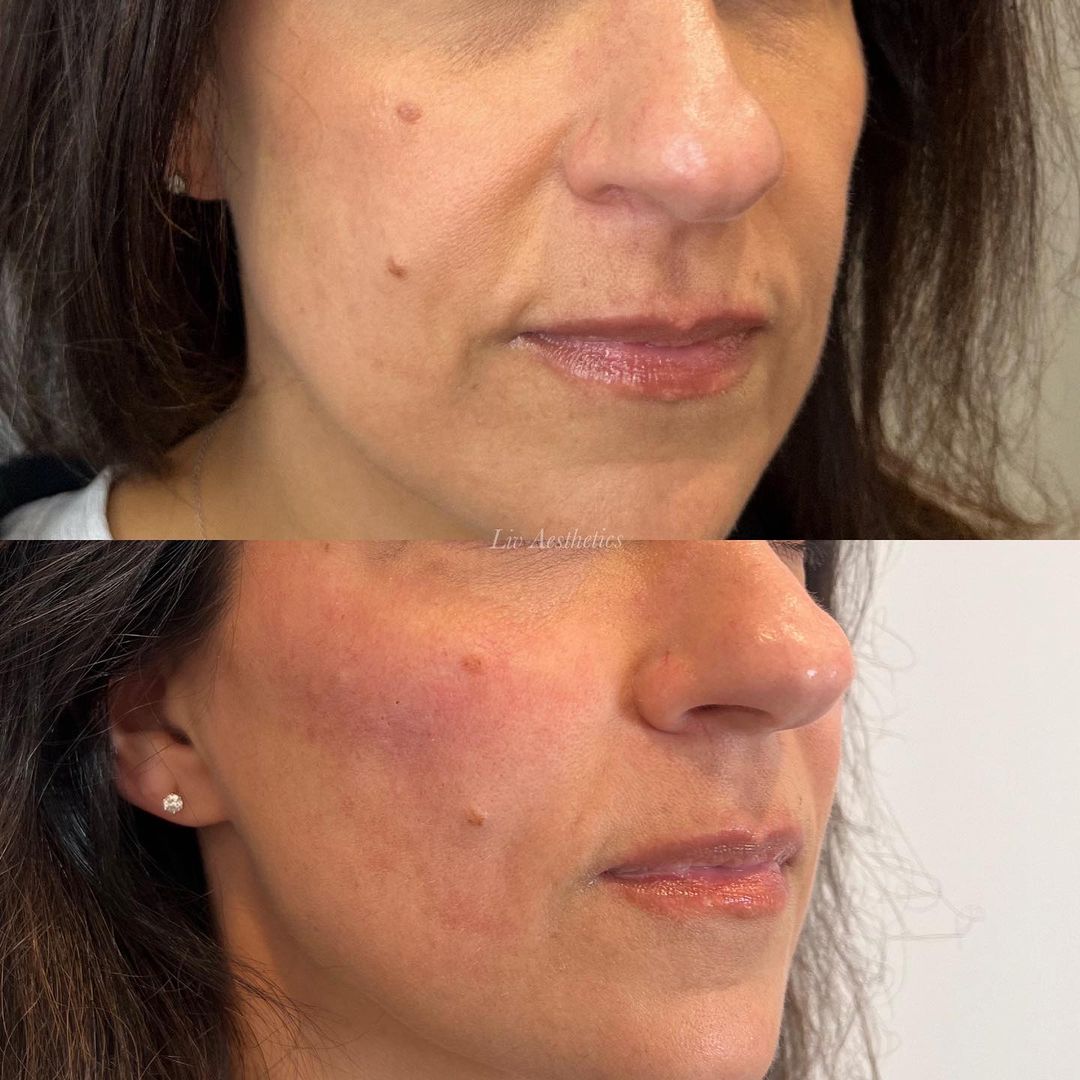 Dermal Fillers before and after photo by Liv Aesthetics Medical Spa in New Fairfield, CT